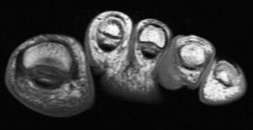 Figure 3 for case Nodular Localized Cutaneous Amyloidosis